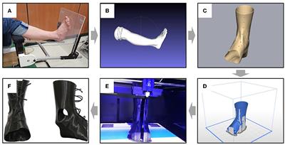 Effects of community ambulation training with 3D-printed ankle–foot orthosis on gait and functional improvements: a case series of three stroke survivors